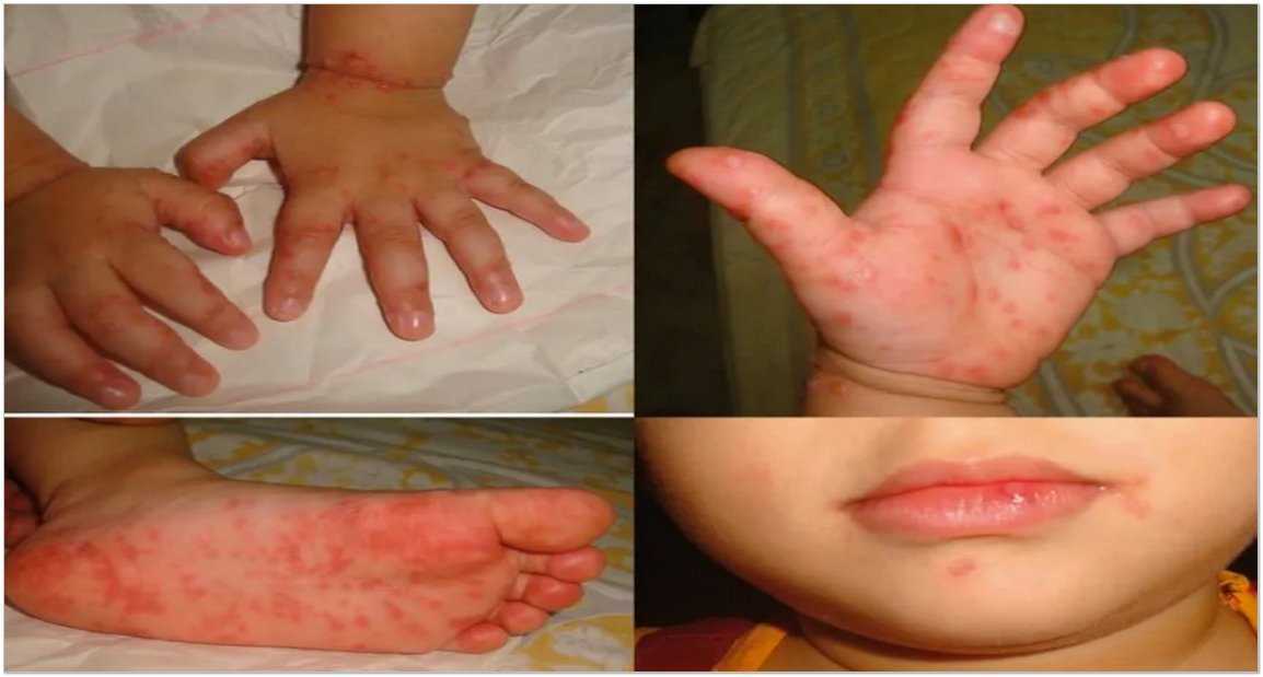 Children s hand foot mouth disease is increasing in schools